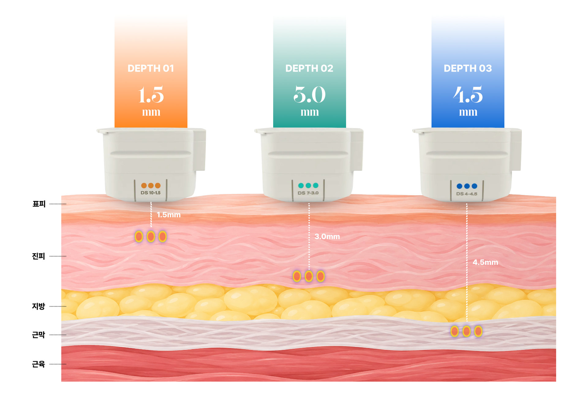 1.5mm, 3.0mm, 4.5mm 깊이의 팁과 표피·진피·지방·근막·근육을 보여주는 모식도